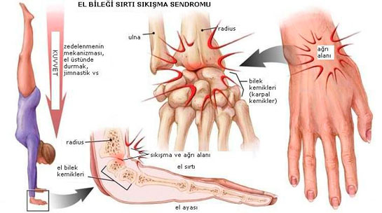 bilekte-sinir-sikismasi.jpg