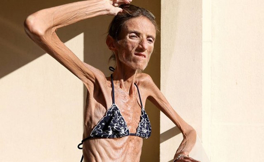 Anoreksiya Belirtileri ve Tedavisi