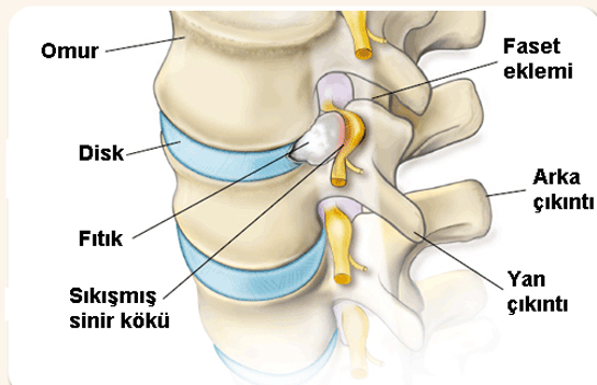 Belde Sinir Sıkışması Belirtileri ve Tedavisi