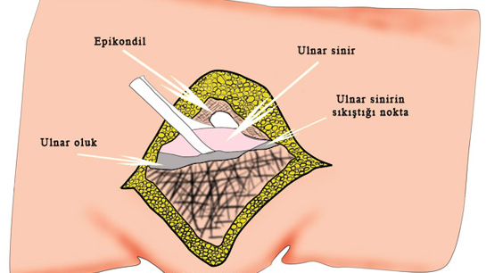 Dirsekte Sinir Skmas