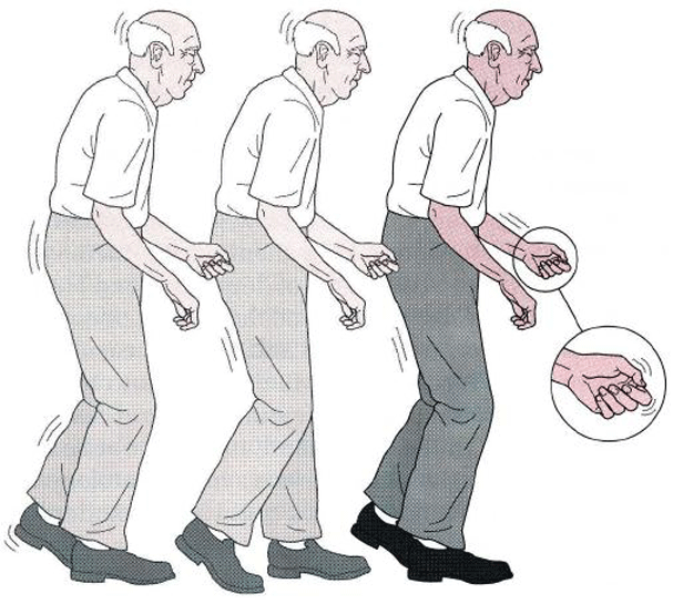 Parkinson Belirtileri ve Tedavisi