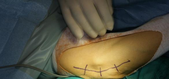 Sinir Sıkışması Tedavisi